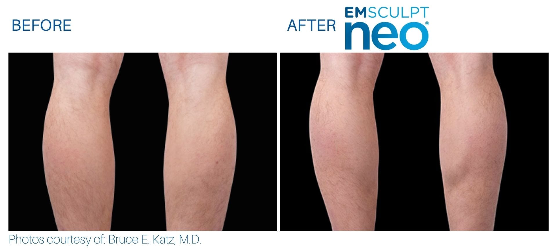 Calves Before And After Emsculpt Neo Treatment At Optimum In Albuquerque, Nm.