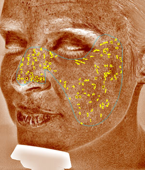 Visia Brown Spots Report