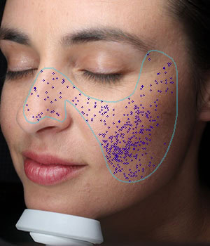 Visia Pores Report
