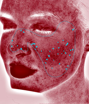 Visia Red Areas Report