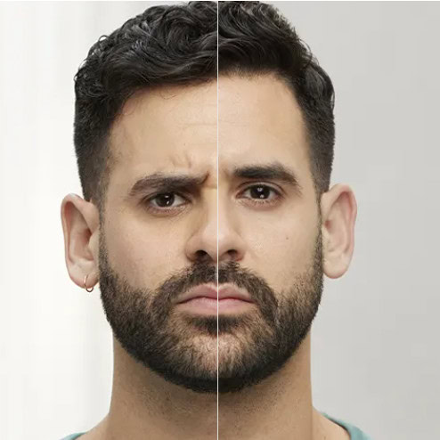 Botox