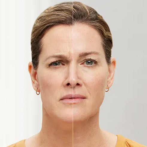 Botox