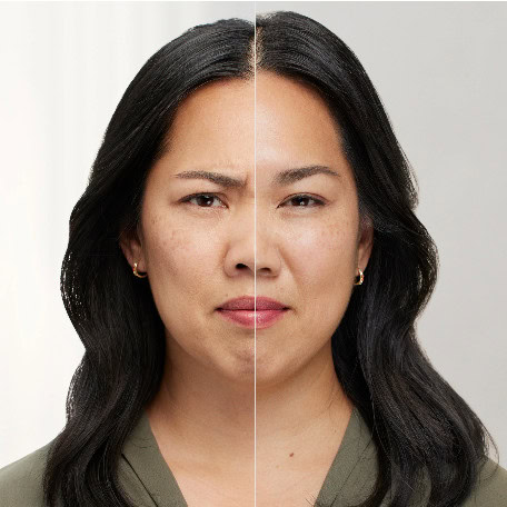Botox
